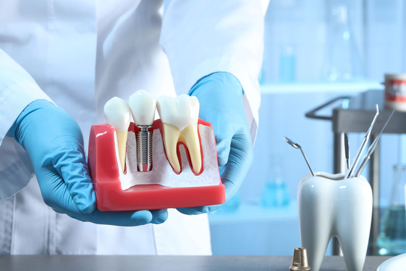 dentist holding up tooth model of dental implant cut away with a tooth shaped tool holder in the back
