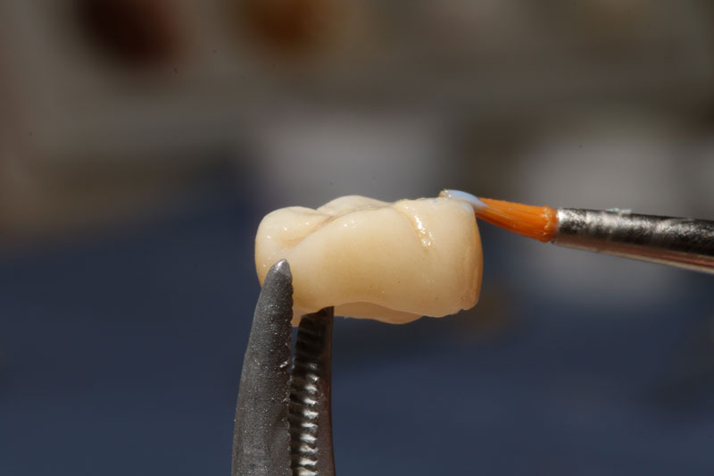 Close-up of a dental crown being prepared with adhesive held by a dental tool. The background is blurred, emphasizing the crown and brush.
