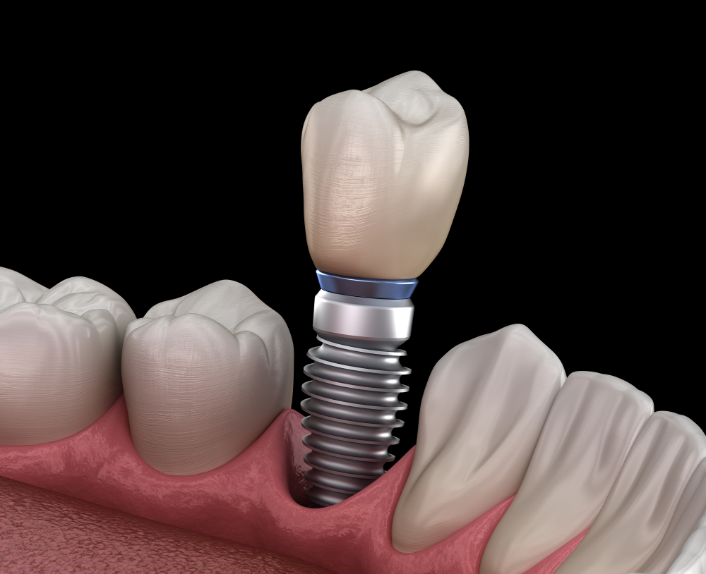 Tooth Implants in Chandler Park - Shutterstock 1408362449
