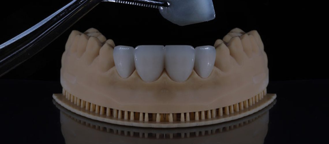 a dental veneer being held by tongs with a full jaw piece holding more
