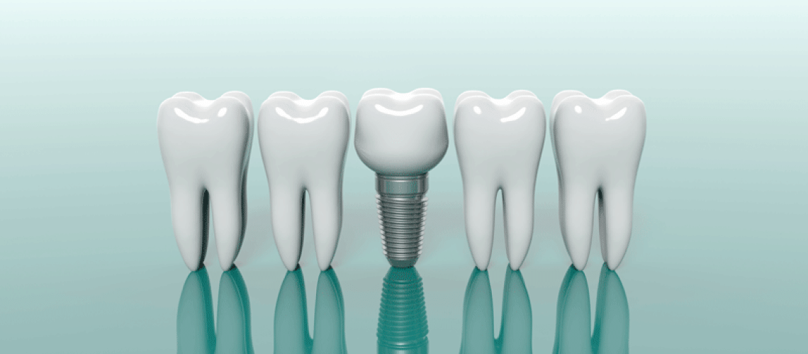 3d model of 4 teeth with a dental implant in the middle of them.