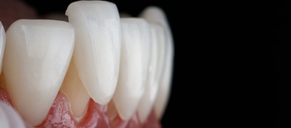 a porcelain veneer being placed onto the tooth